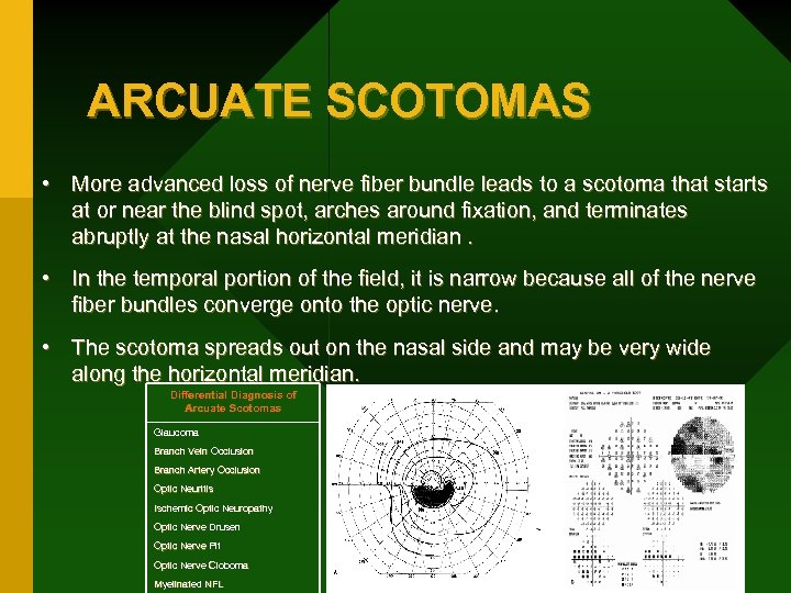 ARCUATE SCOTOMAS • More advanced loss of nerve fiber bundle leads to a scotoma
