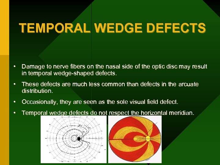 TEMPORAL WEDGE DEFECTS • Damage to nerve fibers on the nasal side of the