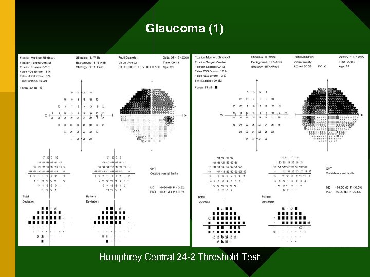 Glaucoma (1) Humphrey Central 24 -2 Threshold Test 