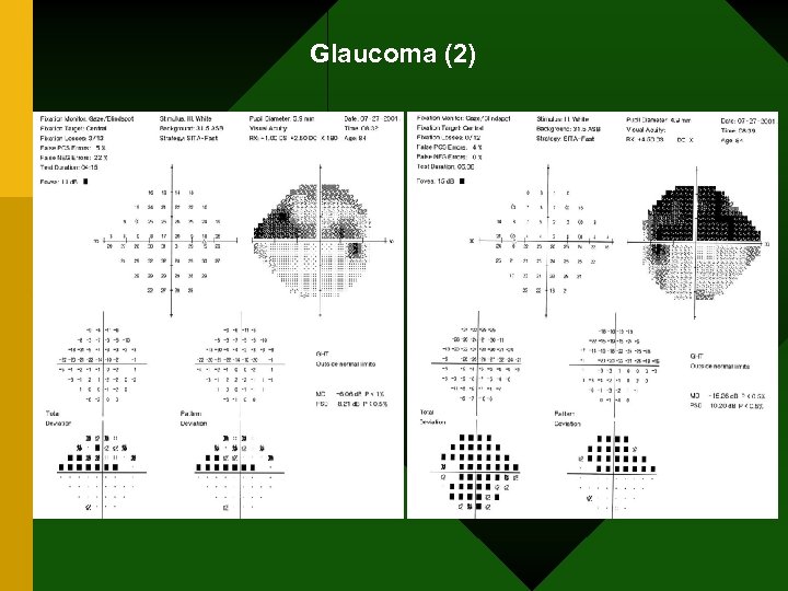Glaucoma (2) 