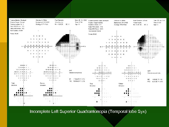 Incomplete Left Superior Quadrantonopia (Temporal lobe Syx) 