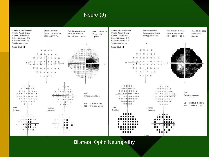 Neuro (3) Bilateral Optic Neuropathy 