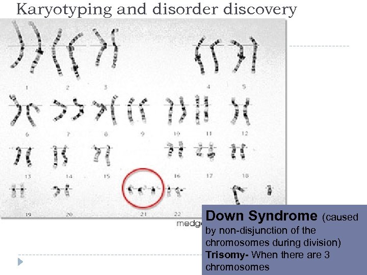 Karyotyping and disorder discovery Down Syndrome (caused by non-disjunction of the chromosomes during division)