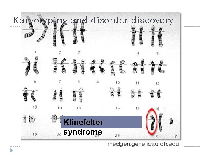 Karyotyping and disorder discovery Klinefelter syndrome 