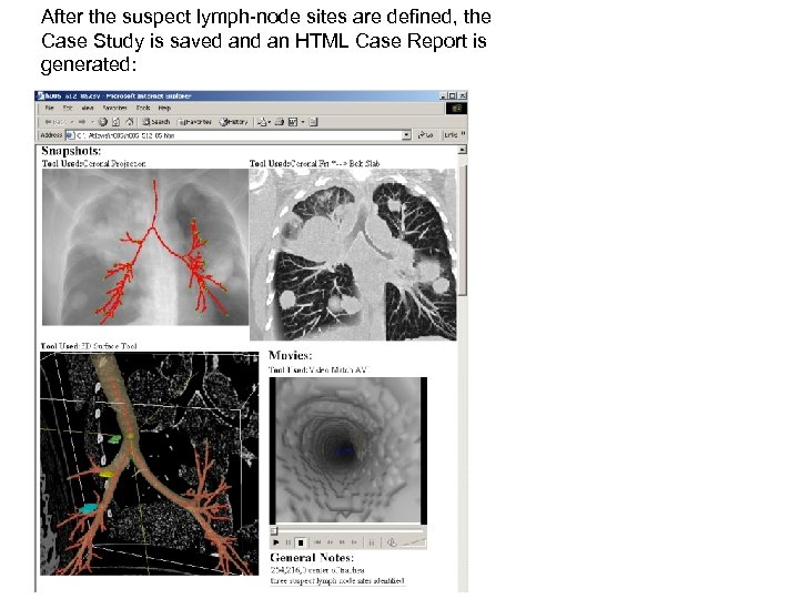 After the suspect lymph-node sites are defined, the Case Study is saved an HTML