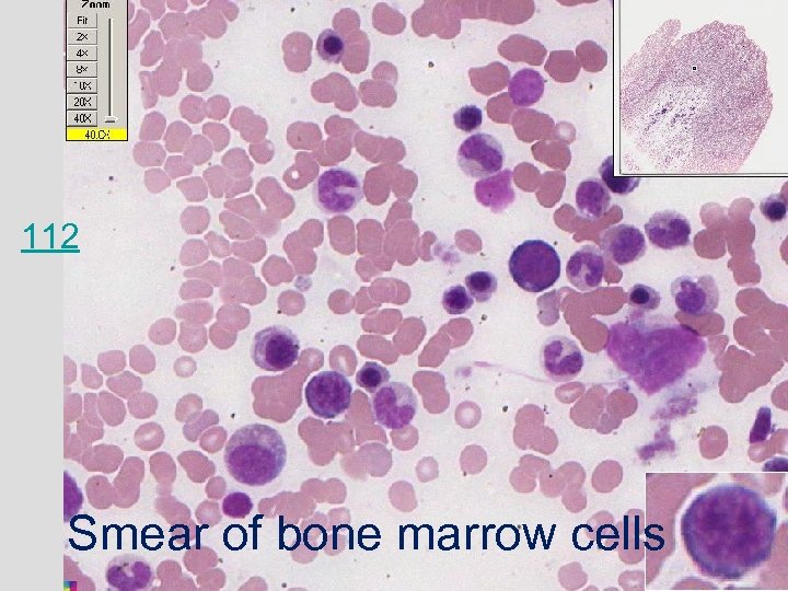 112 Smear of bone marrow cells 