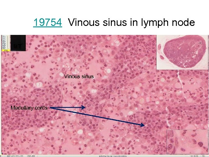 19754 Vinous sinus in lymph node Vinous sinus Medullary cords 