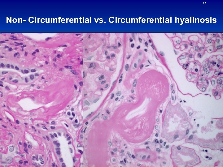 10 Non- Circumferential vs. Circumferential hyalinosis 