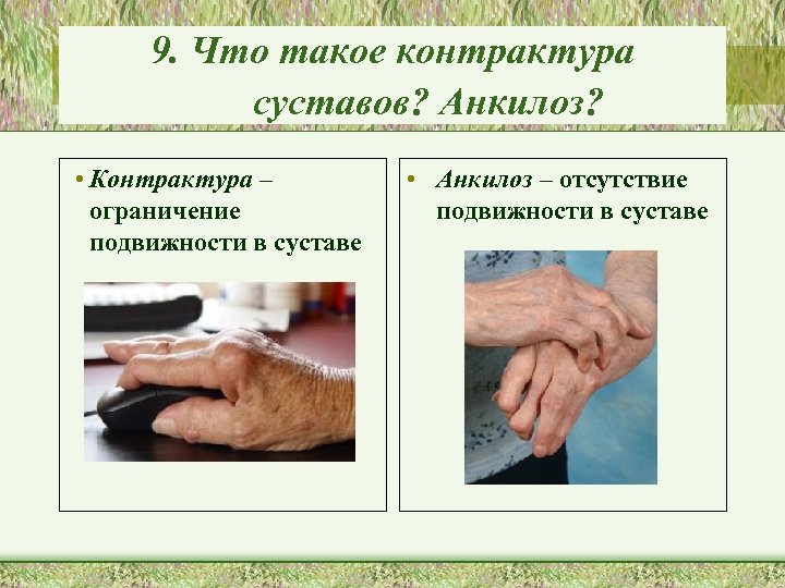 9. Что такое контрактура суставов? Анкилоз? • Контрактура – ограничение подвижности в суставе •