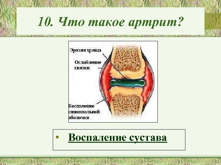 10. Что такое артрит? • Воспаление сустава 