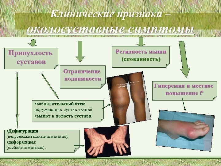 Клинические признаки – околосуставные симптомы Регидность мышц (скованность) Припухлость суставов Ограничение подвижности Гиперемия и