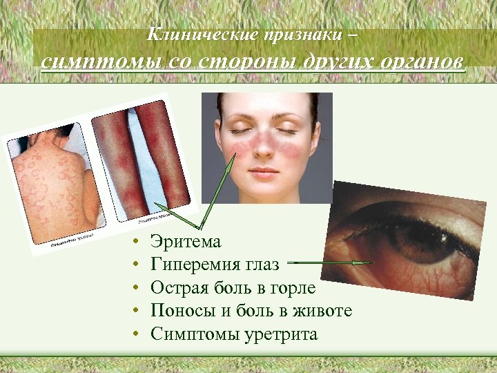 Клинические признаки – симптомы со стороны других органов • • • Эритема Гиперемия глаз