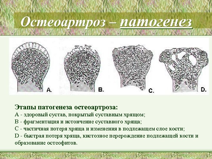 Остеоартроз – патогенез Этапы патогенеза остеоартроза: A - здоровый сустав, покрытый суставным хрящом; B