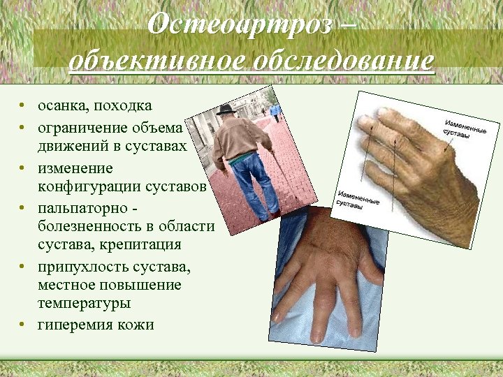 Остеоартроз – объективное обследование • осанка, походка • ограничение объема движений в суставах •