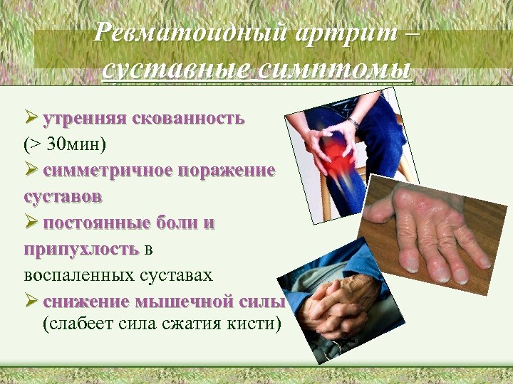 Ревматоидный артрит – суставные симптомы Ø утренняя скованность (> 30 мин) Ø симметричное поражение