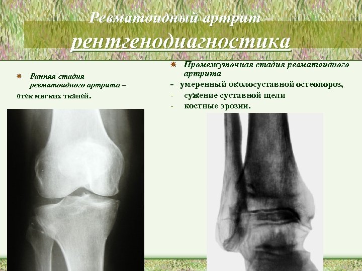 Ревматоидный артрит – рентгенодиагностика Ранняя стадия ревматоидного артрита – отек мягких тканей. Промежуточная стадия