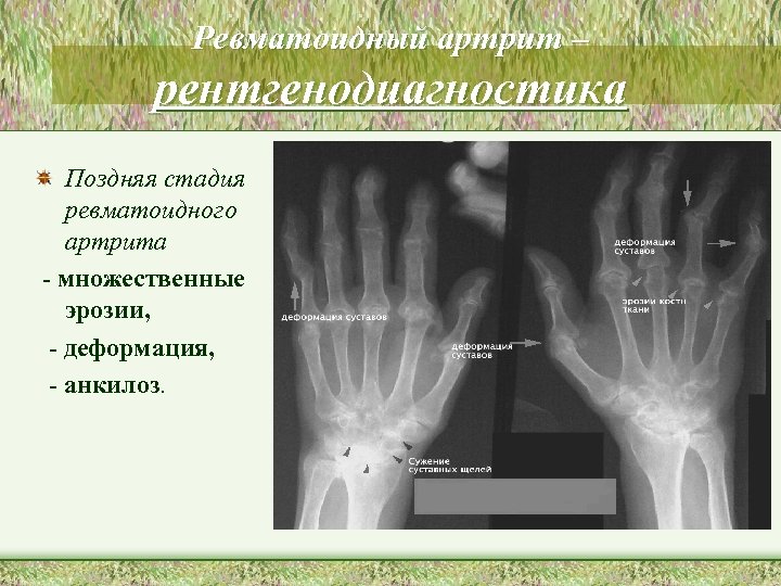 Ревматоидный артрит – рентгенодиагностика Поздняя стадия ревматоидного артрита - множественные эрозии, - деформация, -