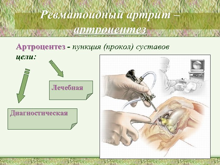 Ревматоидный артрит – артроцентез Артроцентез - пункция (прокол) суставов цели: Лечебная Диагностическая 
