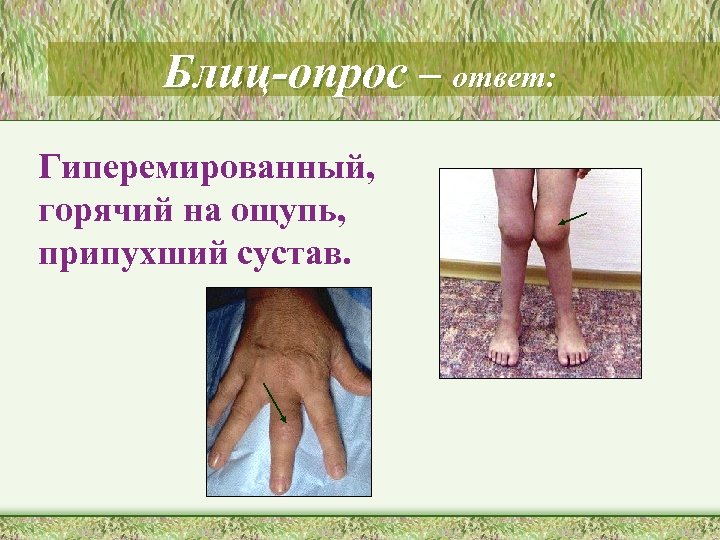 Блиц-опрос – ответ: Гиперемированный, горячий на ощупь, припухший сустав. 