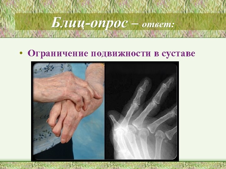 Блиц-опрос – ответ: • Ограничение подвижности в суставе 