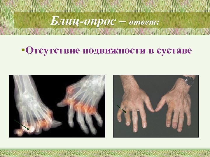 Блиц-опрос – ответ: • Отсутствие подвижности в суставе 