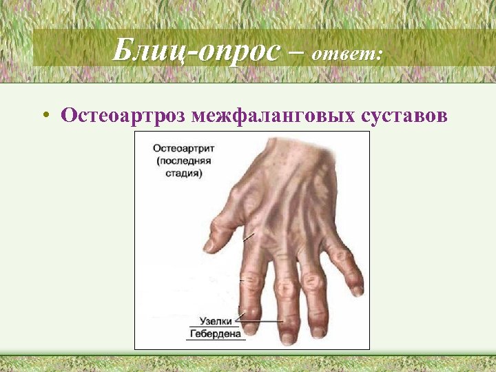 Блиц-опрос – ответ: • Остеоартроз межфаланговых суставов 