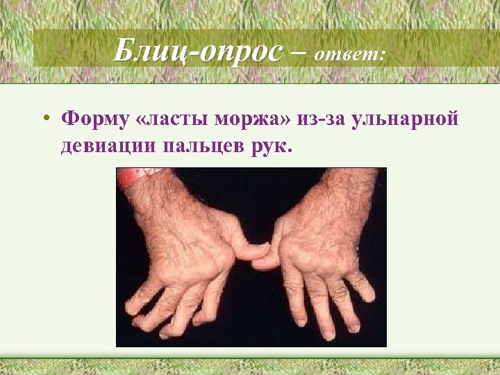 Блиц-опрос – ответ: • Форму «ласты моржа» из-за ульнарной девиации пальцев рук. 