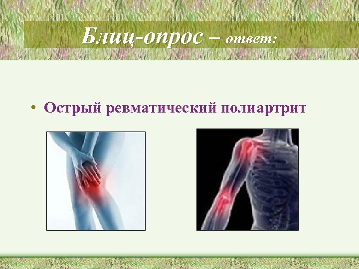 Блиц-опрос – ответ: • Острый ревматический полиартрит 