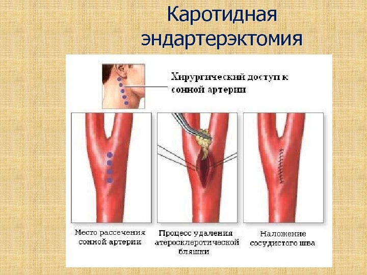 Тромбоз артерий