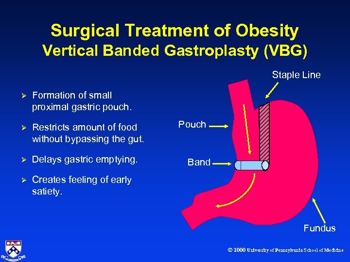Surgical Treatment of Obesity Vertical Banded Gastroplasty (VBG) Staple Line Ø Formation of small