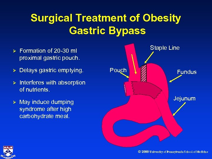 Surgical Treatment of Obesity Gastric Bypass Ø Ø Delays gastric emptying. Ø Interferes with
