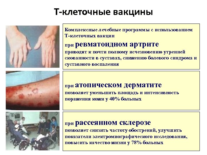 Т-клеточные вакцины Комплексные лечебные программы с использованием Т-клеточных вакцин при ревматоидном артрите приводят к