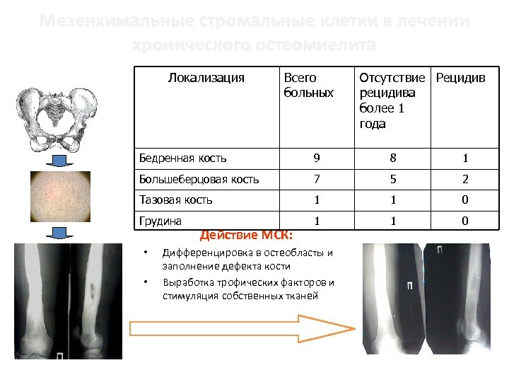 Мезенхимальные стромальные клетки в лечении хронического остеомиелита Локализация Всего больных Отсутствие Рецидив рецидива более