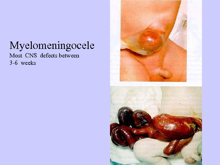 Myelomeningocele Most CNS defects between 3 -6 weeks 