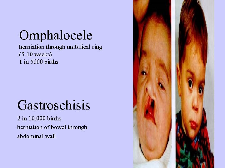 Omphalocele herniation through umbilical ring (5 -10 weeks) 1 in 5000 births Gastroschisis 2