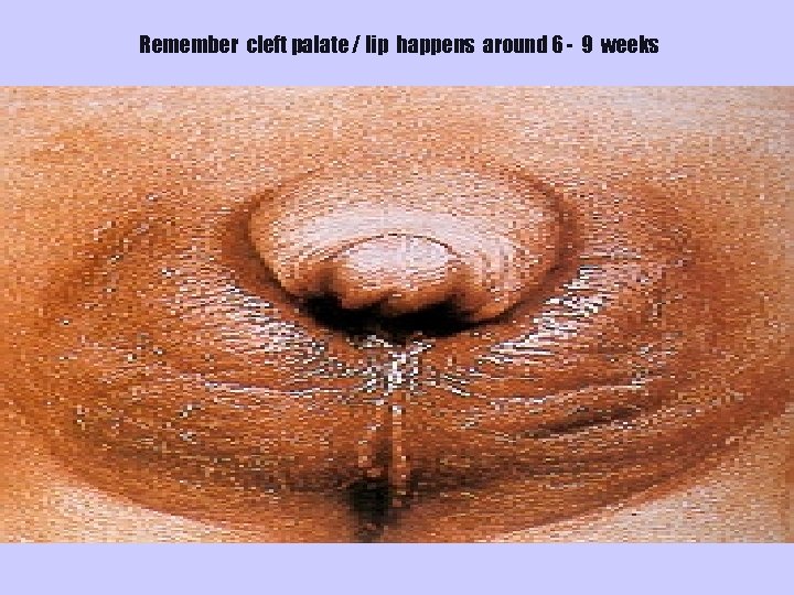 Remember cleft palate / lip happens around 6 - 9 weeks 