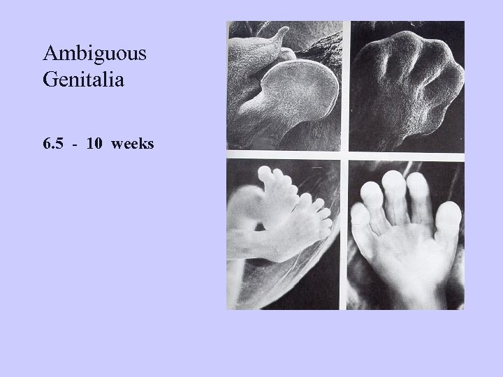 Ambiguous Genitalia 6. 5 - 10 weeks 