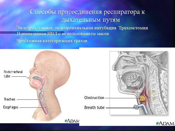 Способы присоединения респиратора к дыхательным путям Эндотрахеальная, эндобронхиальная интубация Трахеостомия Неинвазивная ИВЛ с использованием