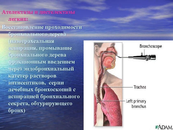 Ателектазы и дистелектазы легких: Восстановление проходимости бронхиального дерева (назотрахеальная аспирация, промывание бронхиального дерева фракционным