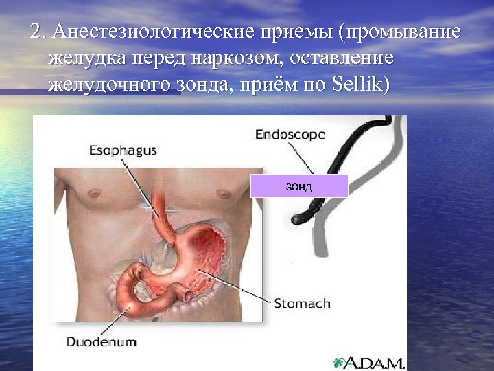 2. Анестезиологические приемы (промывание желудка перед наркозом, оставление желудочного зонда, приём по Sellik) зонд