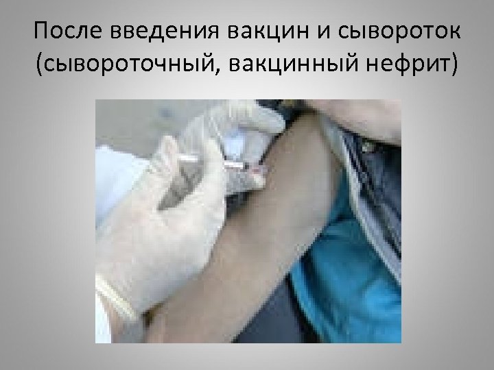 После введения вакцин и сывороток (сывороточный, вакцинный нефрит) 