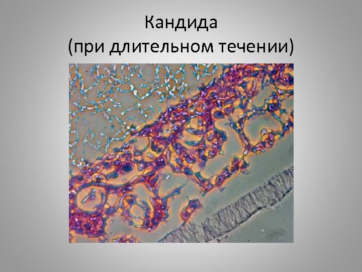 Кандида (при длительном течении) 