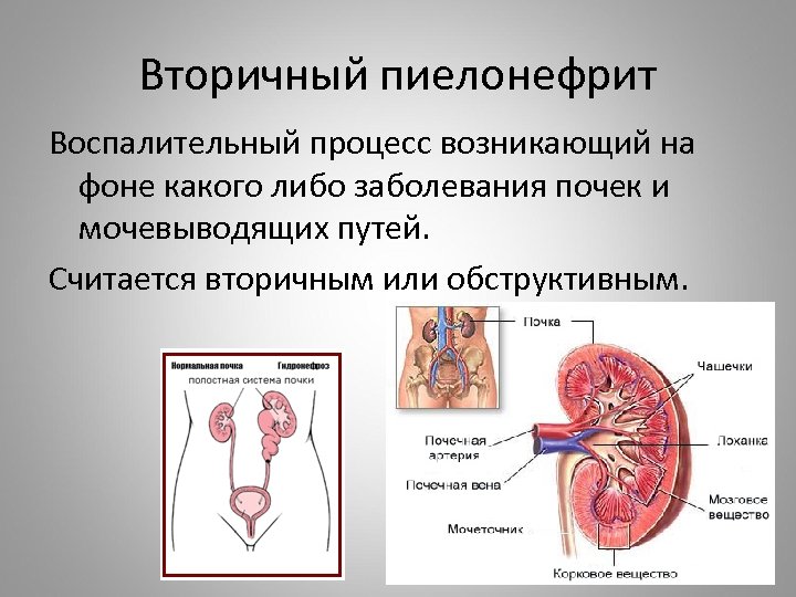 Вторичный пиелонефрит Воспалительный процесс возникающий на фоне какого либо заболевания почек и мочевыводящих путей.