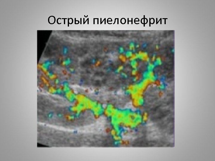 Острый пиелонефрит 