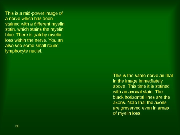 This is a mid-power image of a nerve which has been stained with a