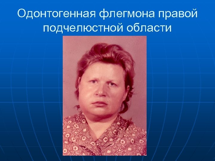 Одонтогенная флегмона правой подчелюстной области 