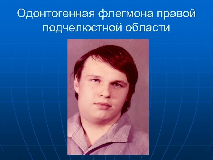 Одонтогенная флегмона правой подчелюстной области 