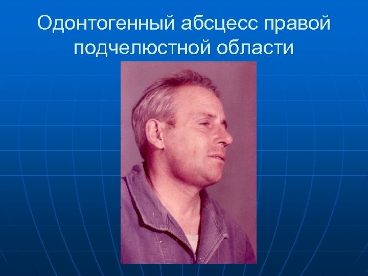 Одонтогенный абсцесс правой подчелюстной области 