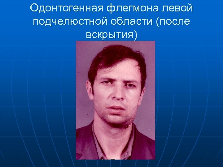 Одонтогенная флегмона левой подчелюстной области (после вскрытия) 