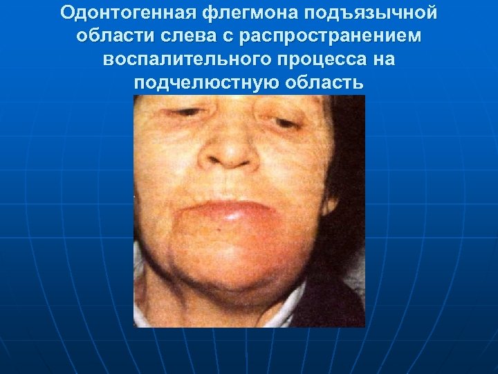 Одонтогенная флегмона подъязычной области слева с распространением воспалительного процесса на подчелюстную область 